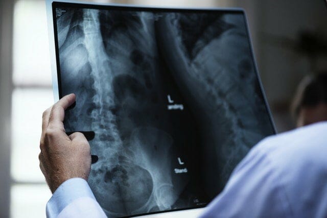 If you've had a serious back injury you may wonder what is my spinal claim worth? See a doctor reviewing a spine xray.
